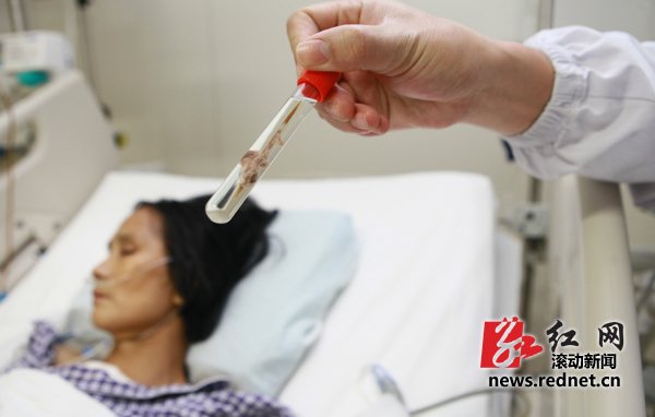 聾啞婦女心臟內(nèi)取出一根6厘米長牙簽(圖)