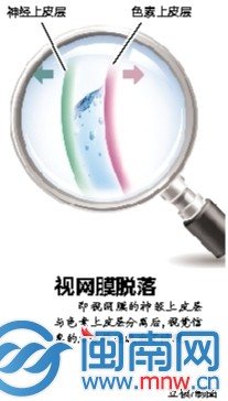 27歲網(wǎng)店店主每天上網(wǎng)超10小時 右眼突然失明